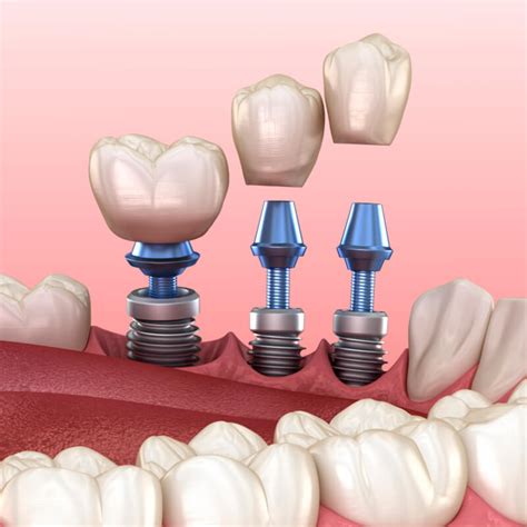 diş implantları hipertansiyon